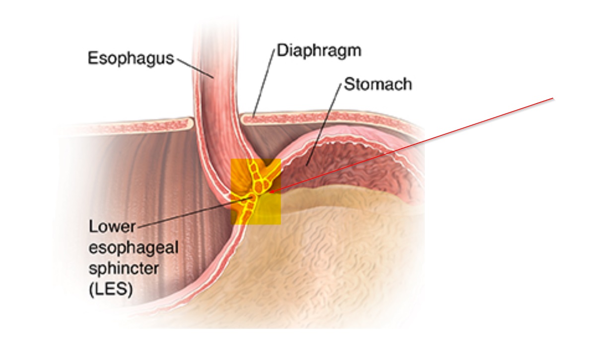 Guide on Heartburn treatment in Kenya and Home Remedies